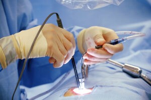 ATTACHMENT DETAILS minimally invasive surgery
